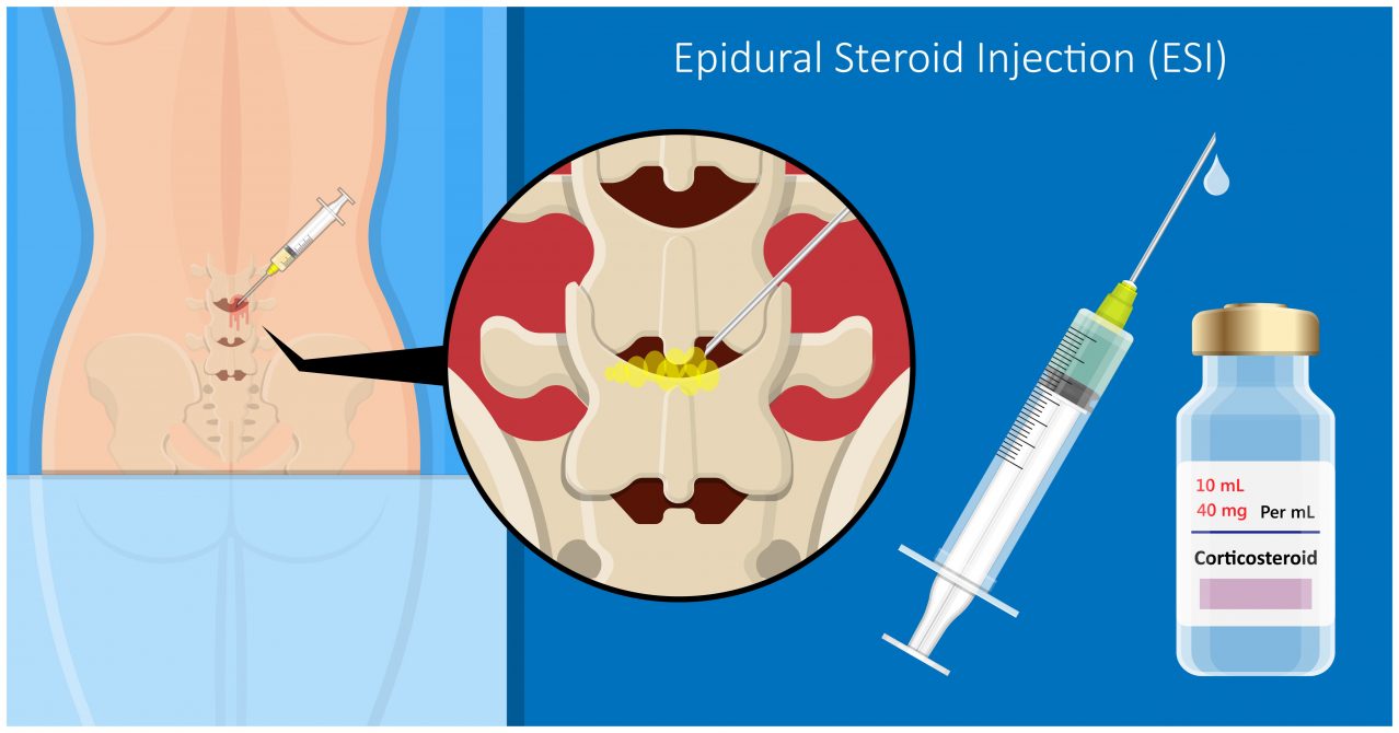 Cortisone Injections My Family Physio