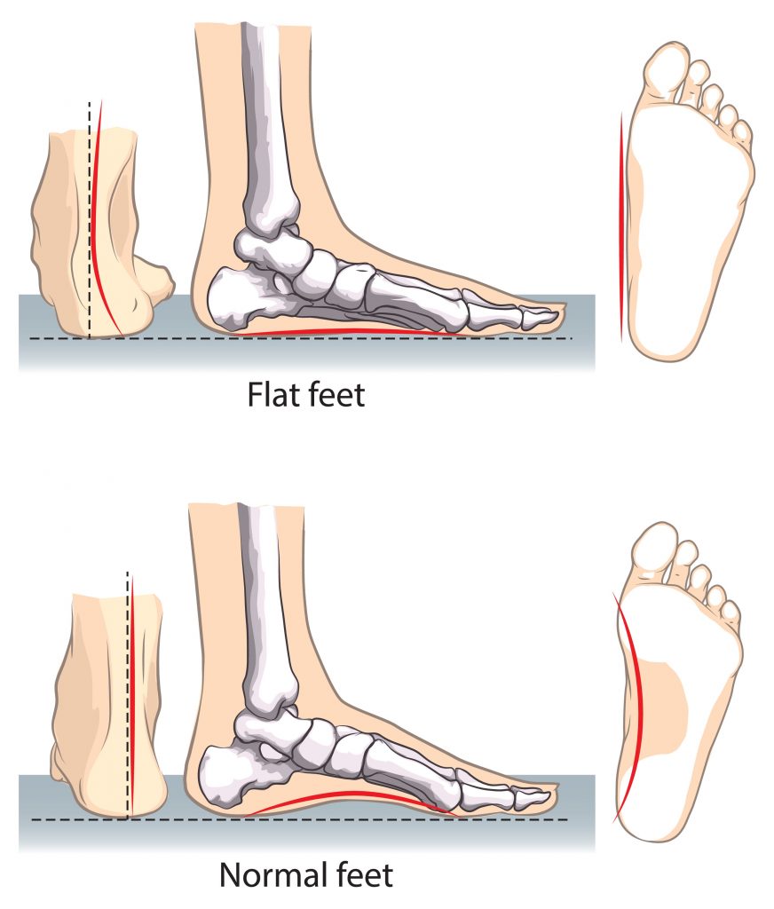 foot pad syndrome