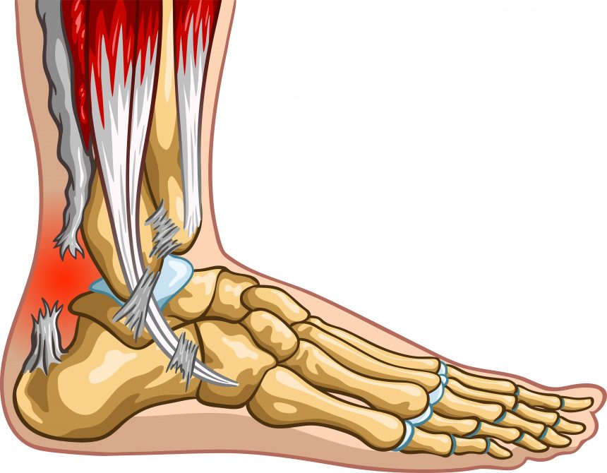 Cortisone Injections - My Family Physio