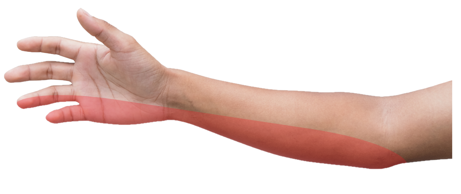 What is Cubital Tunnel Syndrome? Symptoms, Causes, Diagnosis &  Physiotherapy Treatment of Cubital Tunnel Syndrome..