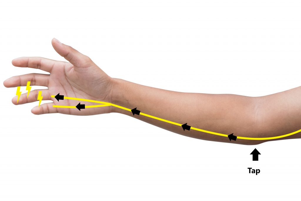 Cubital tunnel syndrome (ulnar nerve compression neuropathy)