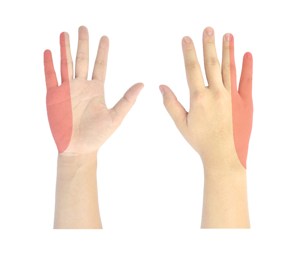 Cubital Tunnel Syndrome - What it is and what you can do about it -  Canberra Hand Therapy