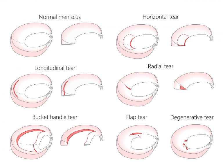 Meniscus Injuries - My Family Physio