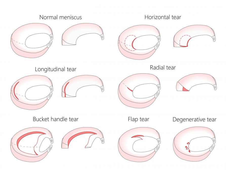 Meniscus Injuries - My Family Physio