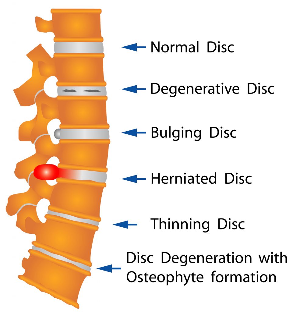 Lower Back Injuries, Common Injuries