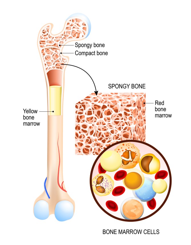 bone marrow degenerative changes