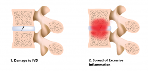 Modic Changes - My Family Physio