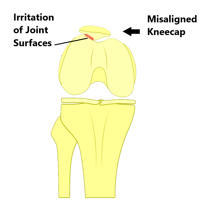 Misaligned kneecap deals