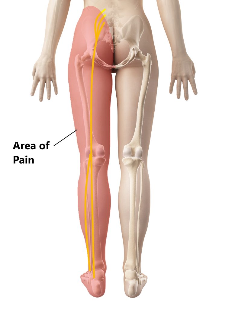 Diagnosing Lateral Thigh Pain: IT band syndrome, Hip Bursitis and referred  Back pain - Reid Clinic