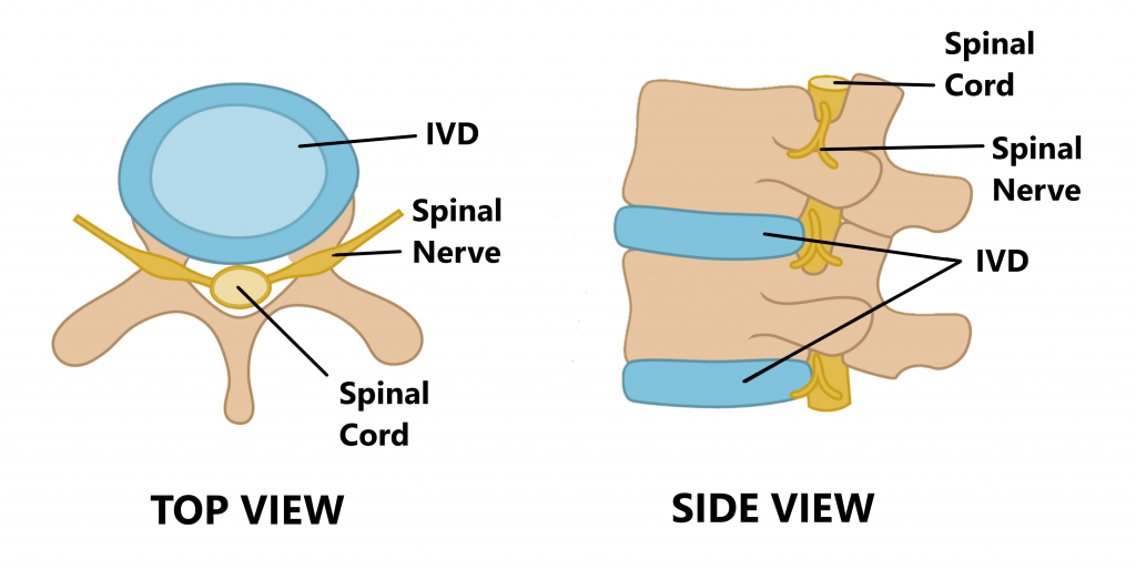 The two most common causes of sciatica. A: Normal IVD, thecal sac with