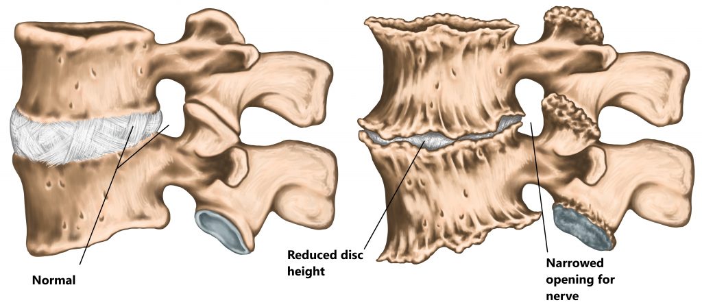 The two most common causes of sciatica. A: Normal IVD, thecal sac with