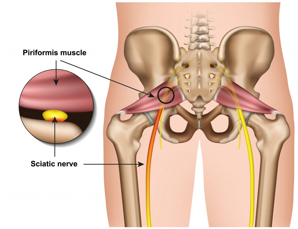 Sciatica My Family Physio