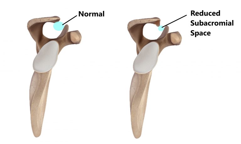 Shoulder Impingement - My Family Physio