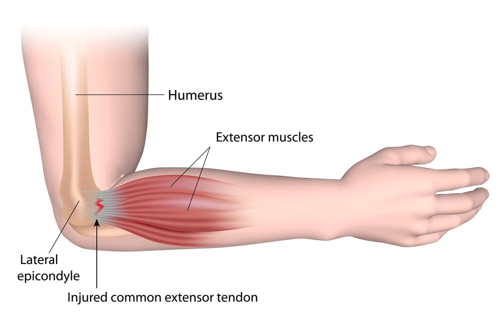 Extensor Tendonitis: What It Is, Causes & Treatment