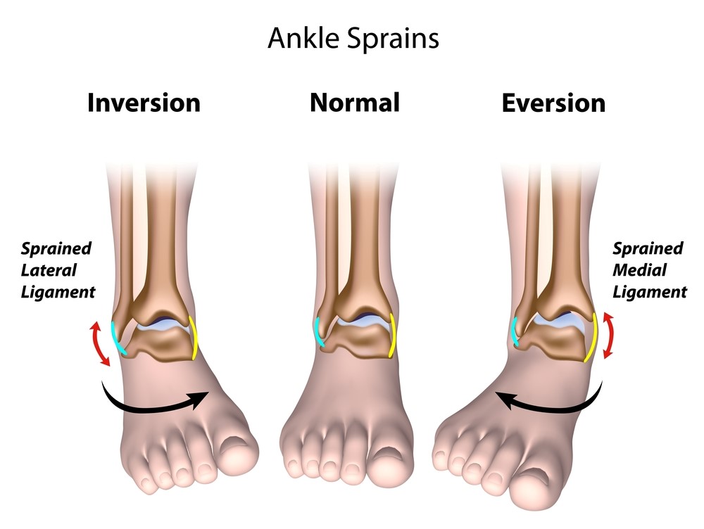 Common Ankle Injuries - My Family Physio