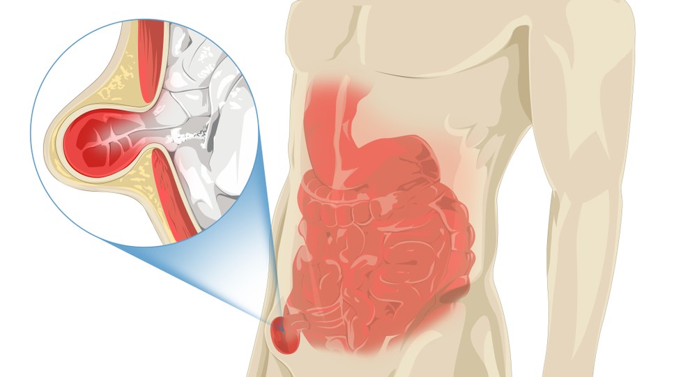 Common Groin Injuries - My Family Physio