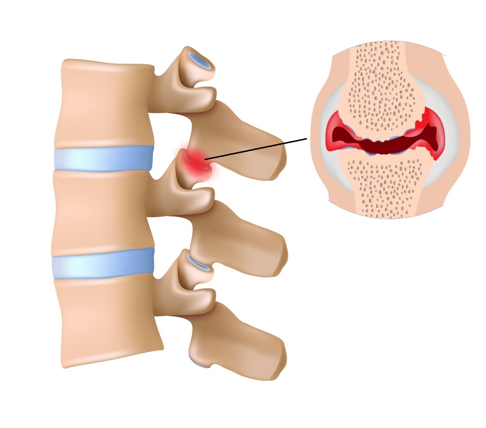 neck facet syndrome symptoms