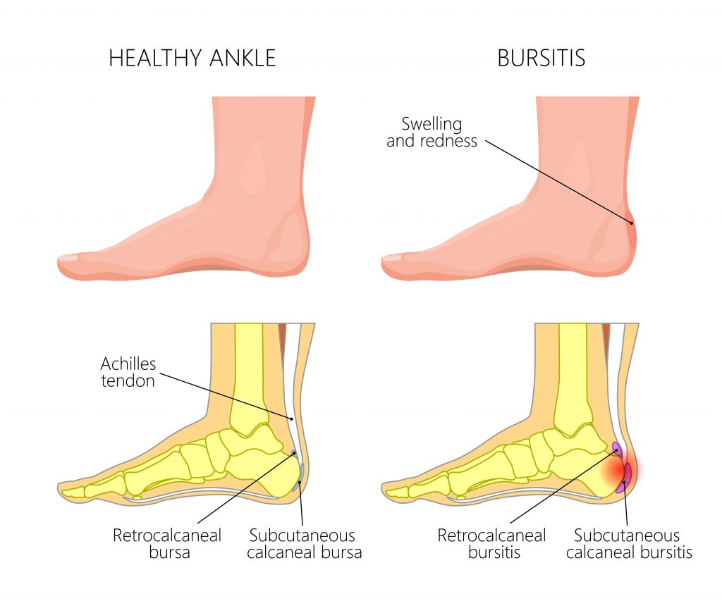 Achilles Tendon Rupture: Treatment, Therapies, and Recovery