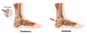 Achilles Tendon Injuries - My Family Physio