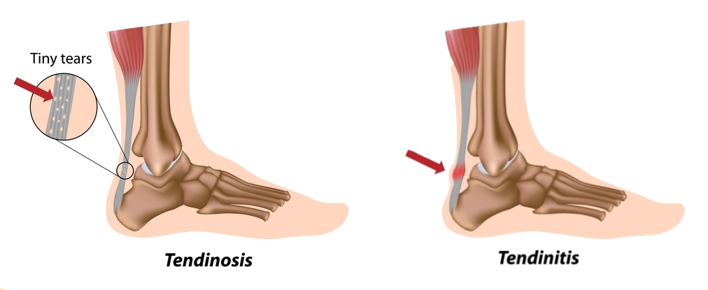 Strapping for hot sale achilles bursitis