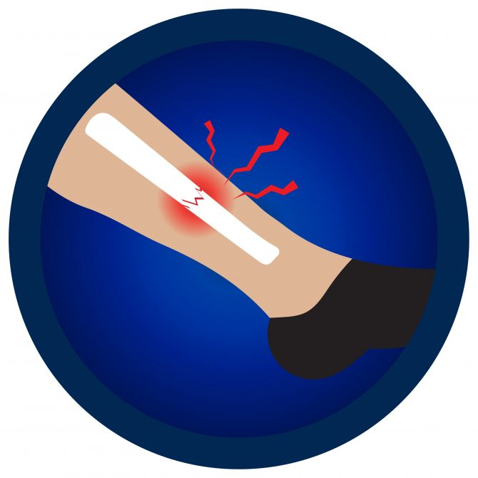Common Lower Leg and Calf Injuries - My Family Physio