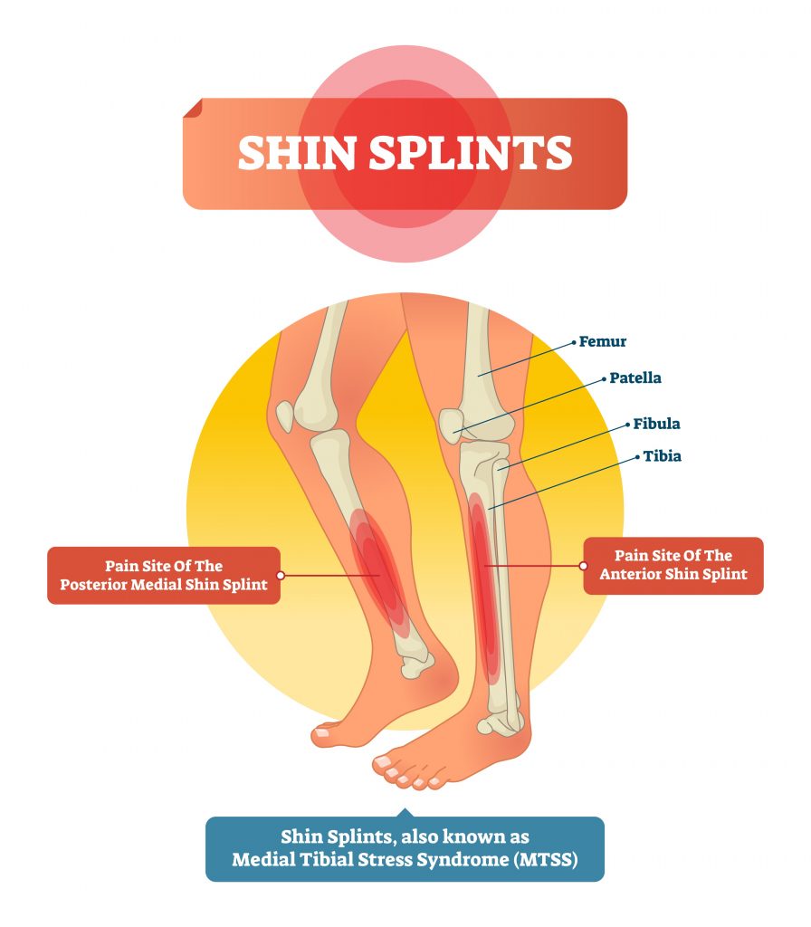 Common Lower Leg and Calf Injuries My Family Physio