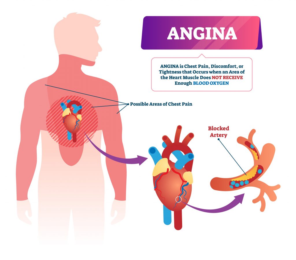 Upper Chest Discomfort Lokasinbets   Common Chest And Upper Back Injuries Angina  1024x900 