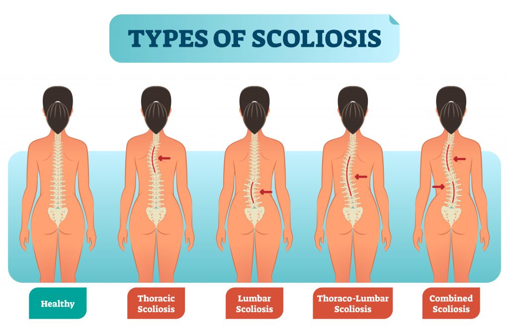 https://myfamilyphysio.com.au/wp-content/uploads/2020/08/common-chest-and-upper-back-injuries-scoliosis--1024x664.jpg