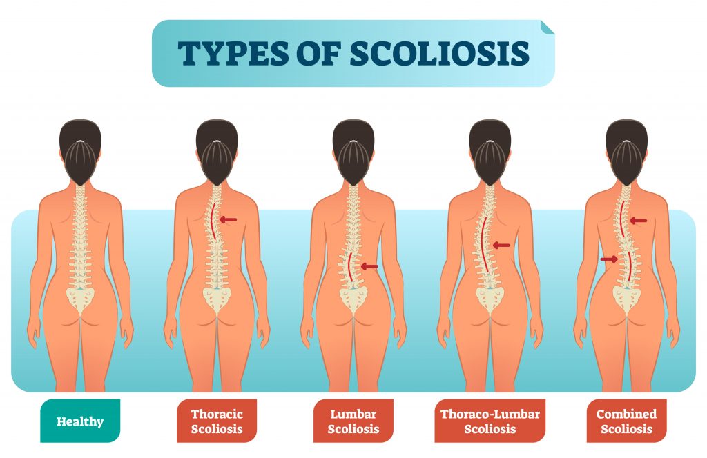 Common Upper Back And Chest Injuries My Family Physio