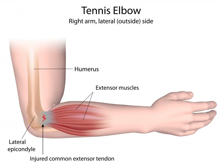 Common Elbow Injuries My Family Physio