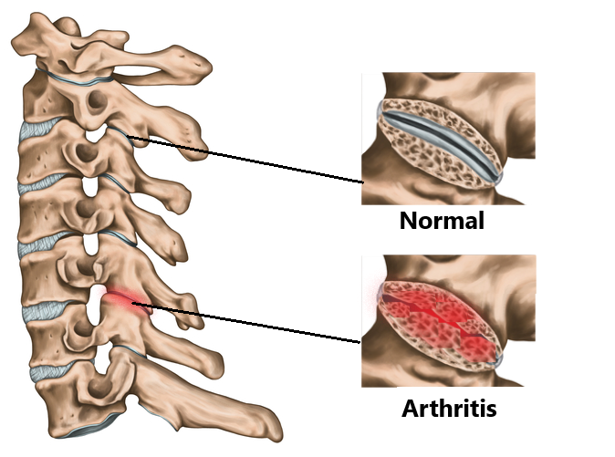 Common Neck Injuries in Sports