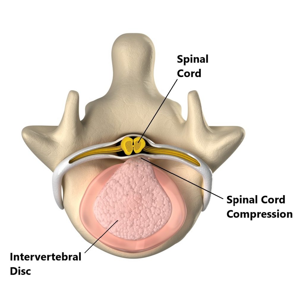 Lower Back Injuries, Common Injuries