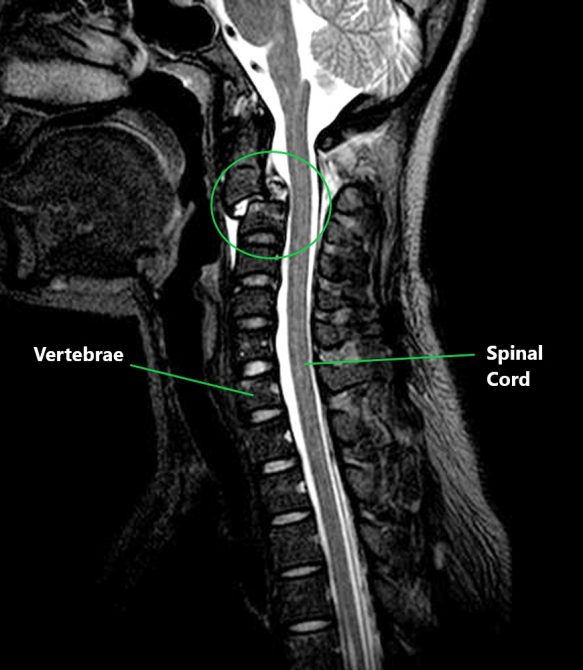 Common Neck Injuries - My Family Physio