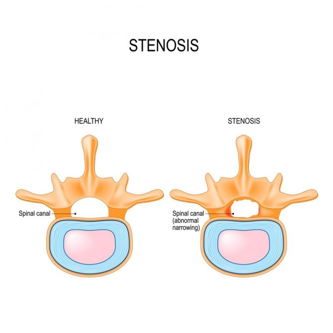 Common Neck Injuries My Family Physio