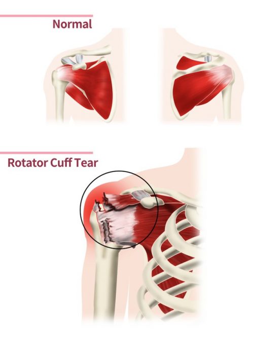 Common Shoulder Injuries - My Family Physio