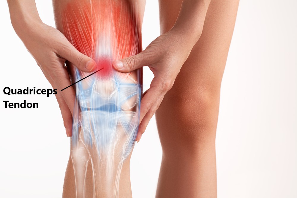 Common Thigh Injuries My Family Physio