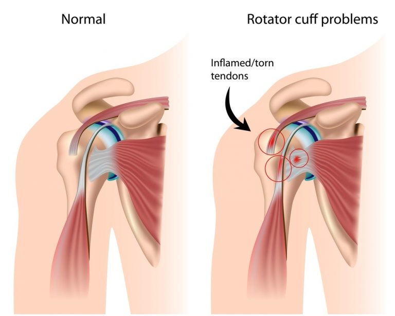 common-shoulder-injuries-my-family-physio