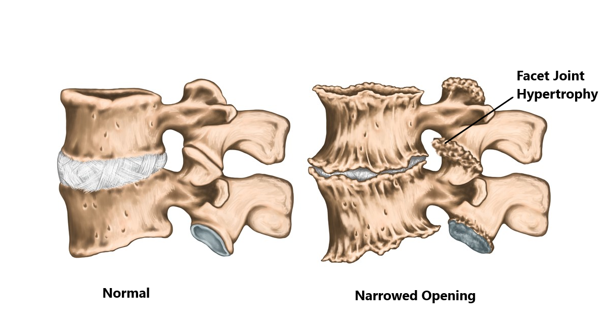 Facet Joint Hypertrophy Lumbar Spine at Steve Harwell blog