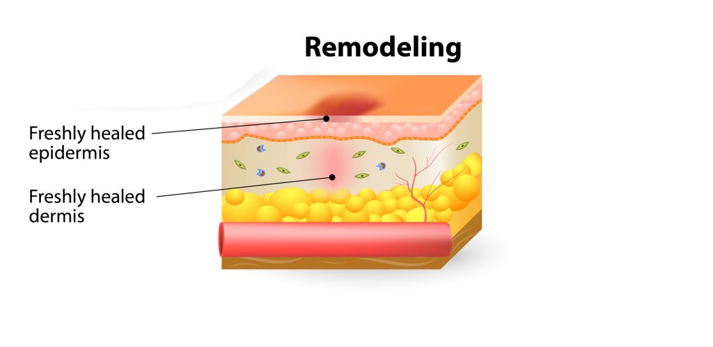 Type 1 To Type 3 Collagen Ratio In Remodelling Phase