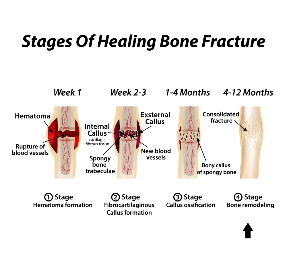 healing-of-a-bone-fracture-nursing-board-nursing-study-nursing-tips