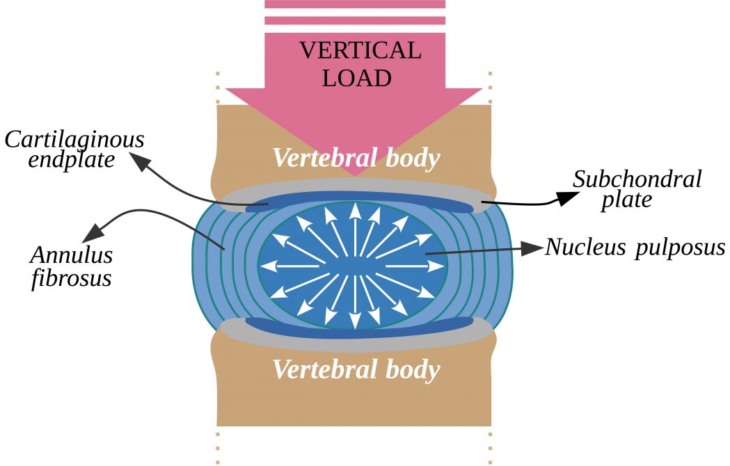 intervertebral-disc-injuries-my-family-physio