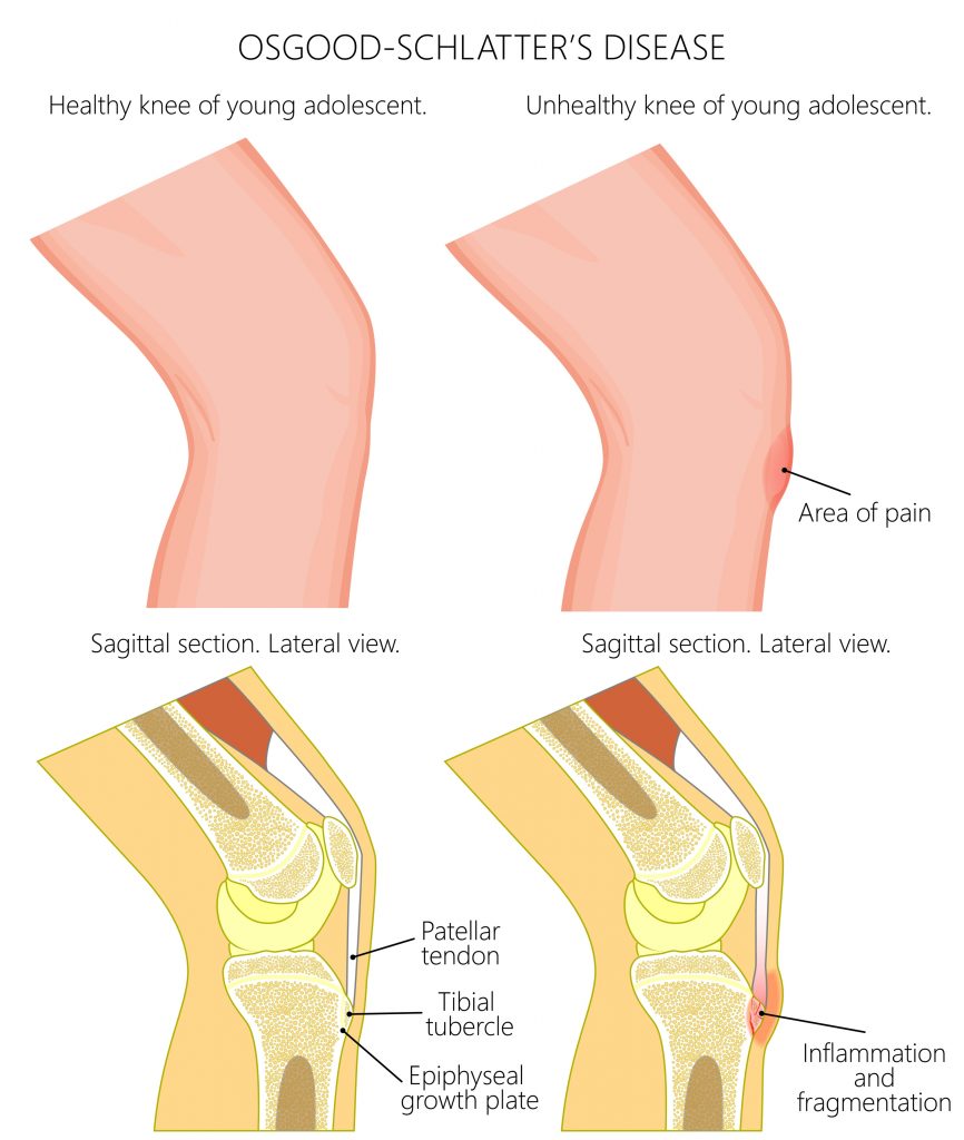 Partially dislocated deals knee symptoms