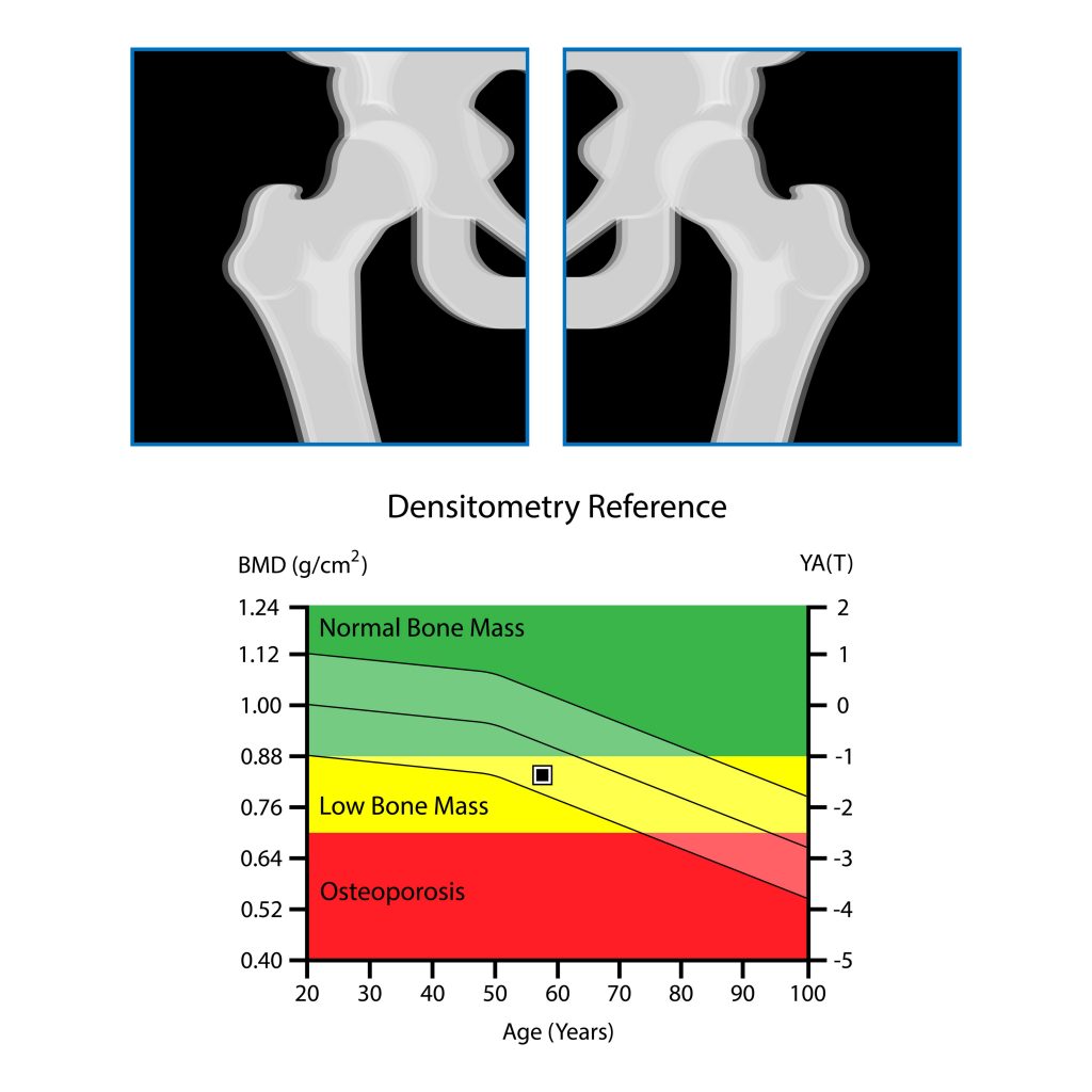 maintaining-bone-density-and-boosting-brittle-bones-richmond