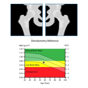 Osteoporosis - My Family Physio