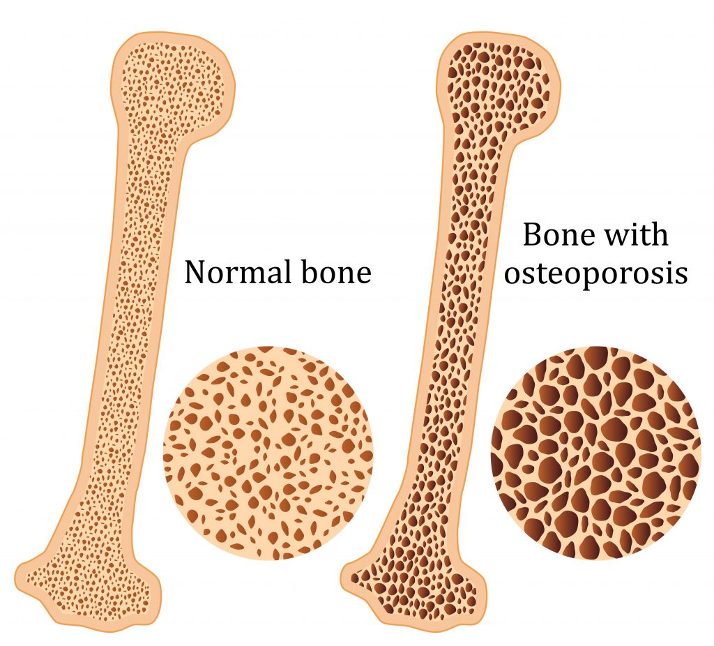 Osso Com Osteoporose Imagem - LIBRAIN