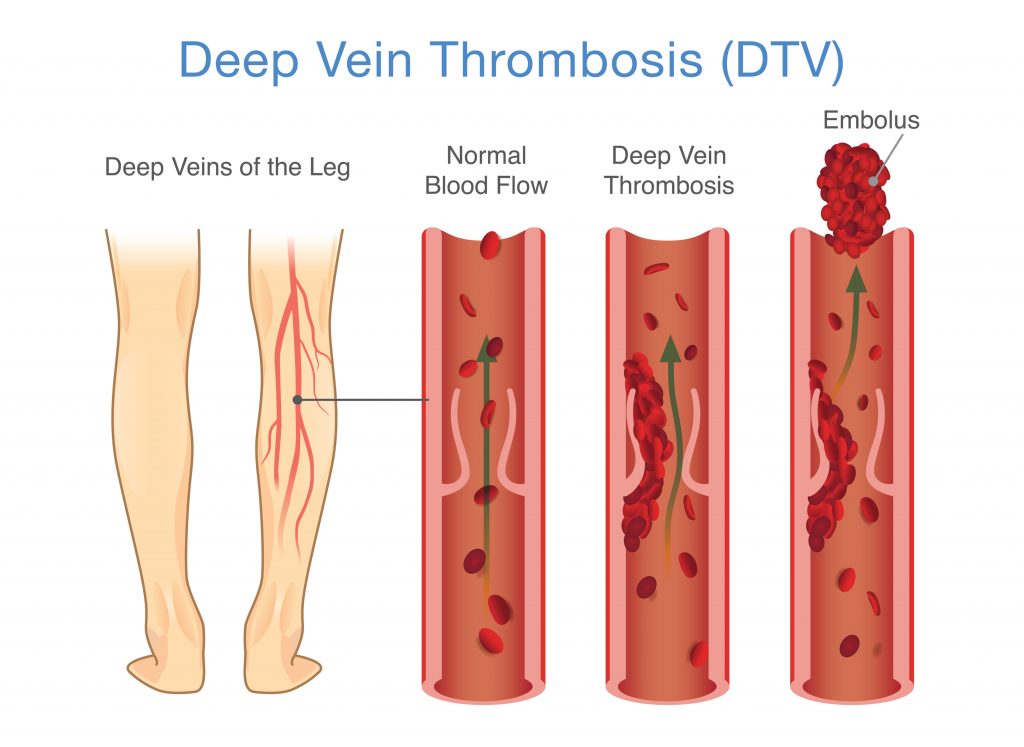 Deep Vein Thrombosis Treatment Sydney