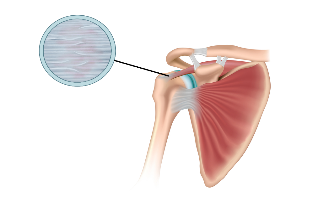 Rotator deals cuff trauma