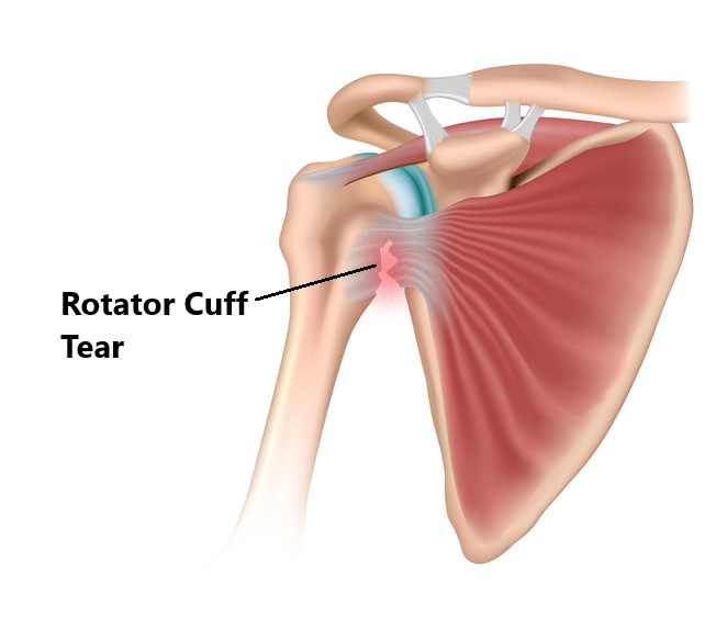 Anatomic description of degenerative rotator cuff tear. The common site