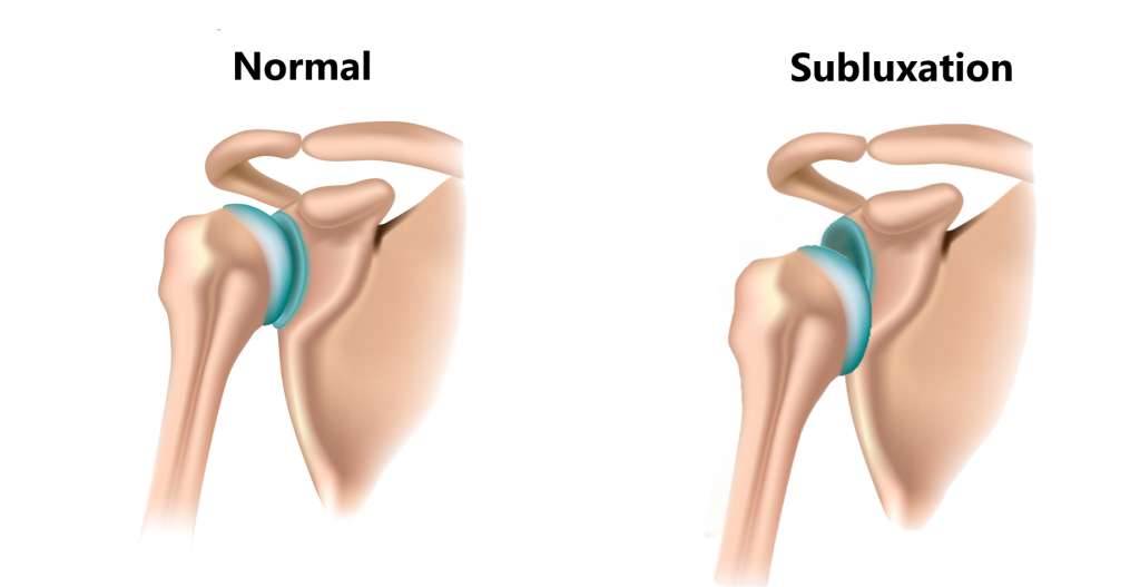 shoulder-dislocations-my-family-physio