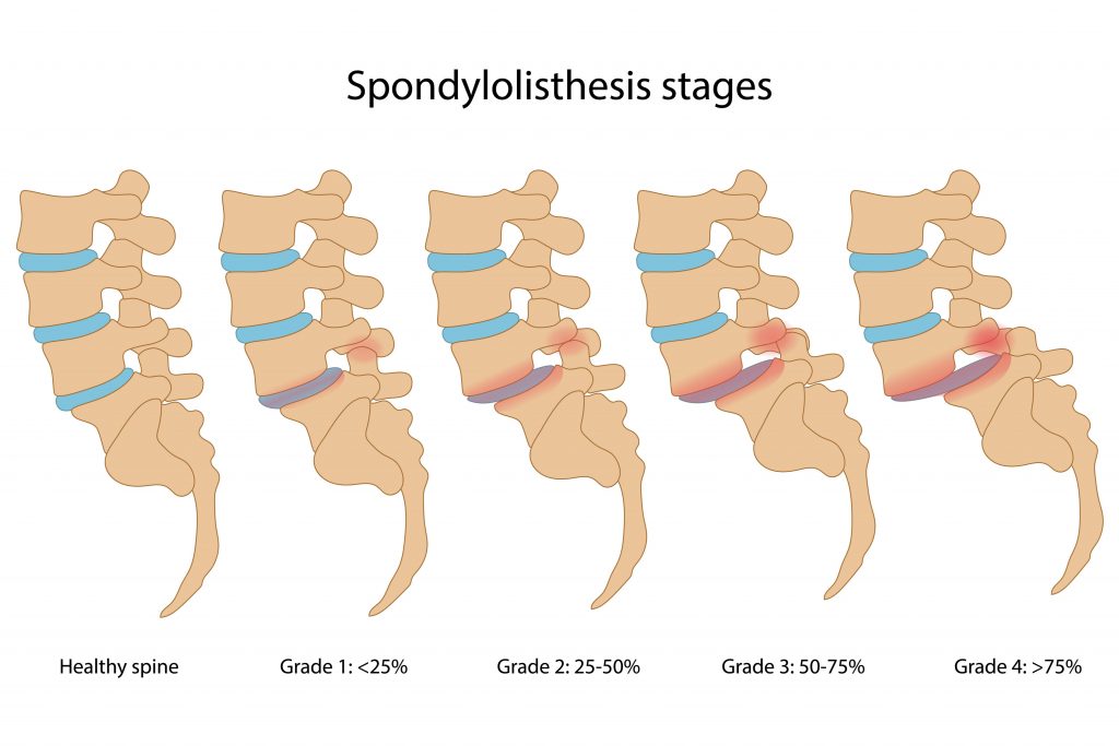 Facet Joint Injuries - My Family Physio